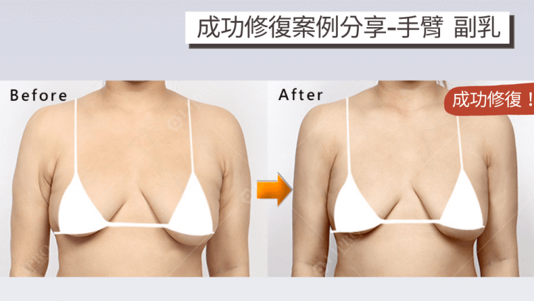 抽脂後凹凸不平的手臂和腋下副乳部位可透過顯微套管抽脂術改善