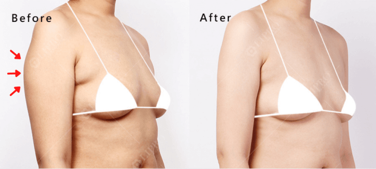 人體各區域的脂肪軟硬程度不同，醫師須掌握脂肪特性才能有成功的抽脂效果