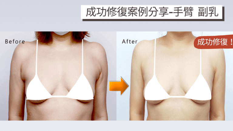 抽脂失敗修復案例分享，手臂副乳抽脂失敗案例二次手術前後對比