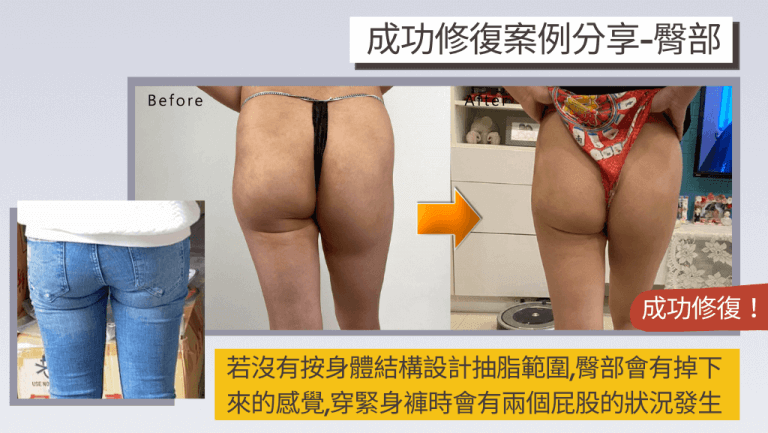 個案因大腿環抽手術失敗，抽脂後屁股下垂，經李咏馨醫師修復後改善許多