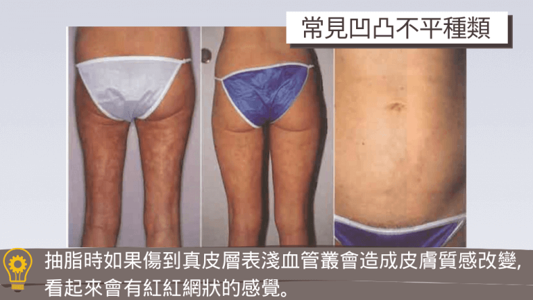 圖片展示抽脂失敗常見的狀況之一:皮膚質感改變、呈現紅紅的網狀紋路