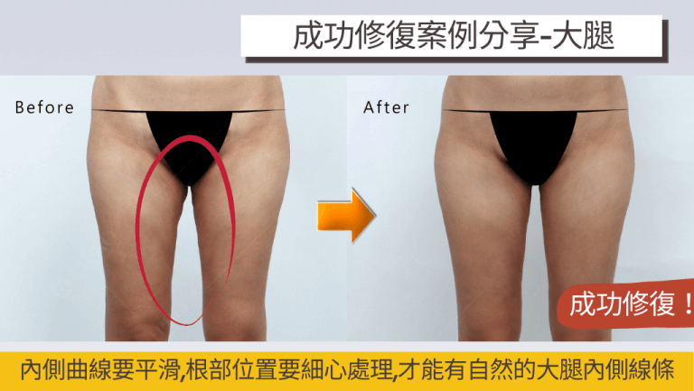 腿部抽脂成功的關鍵1.大腿根部要細心處理，才能有平順的內側曲線