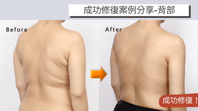 個案因背部抽脂失敗後在背後留下了一條一條的抽脂痕跡