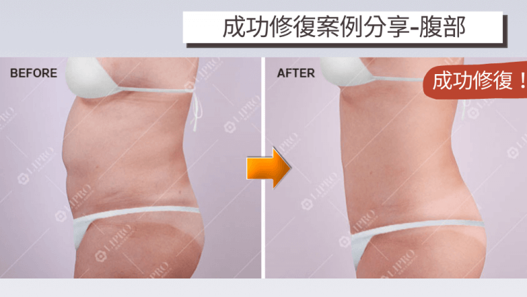 麗波分享個案於他院抽脂失敗後，凹陷的腹部經顯微套管抽脂修復取線獲得改善