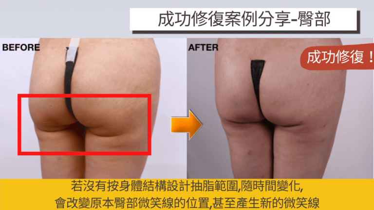 若抽脂規劃時並未考慮身體結構，容易有臀部變形、微笑線改變的抽脂失敗狀況發生