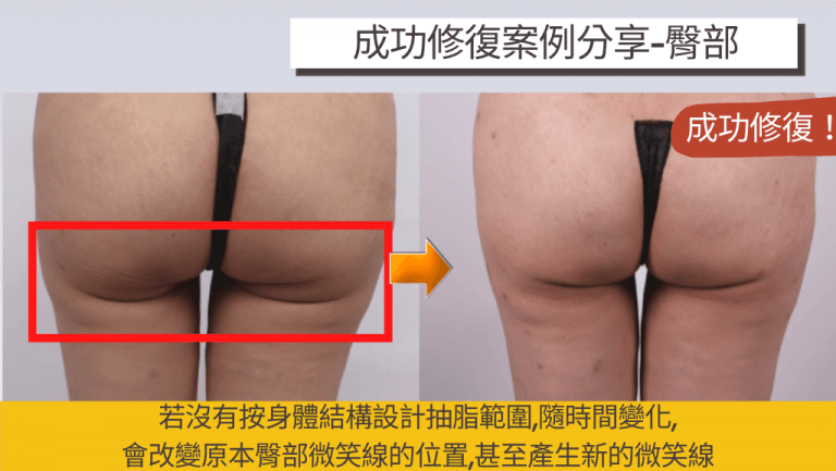 臀部抽脂若欠缺身體結構考量，可能導致臀部微笑線的位置改變