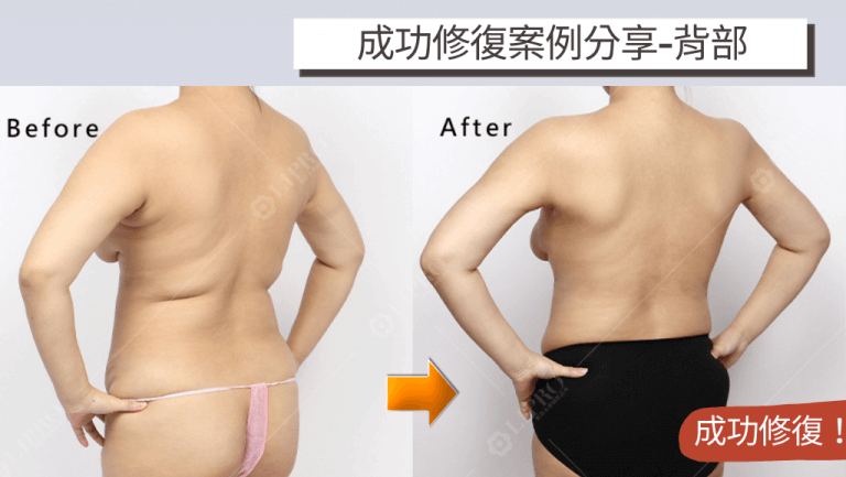 個案在背部抽脂失敗產生的凹凸不平狀況藉由二次修復手術獲得明顯改善