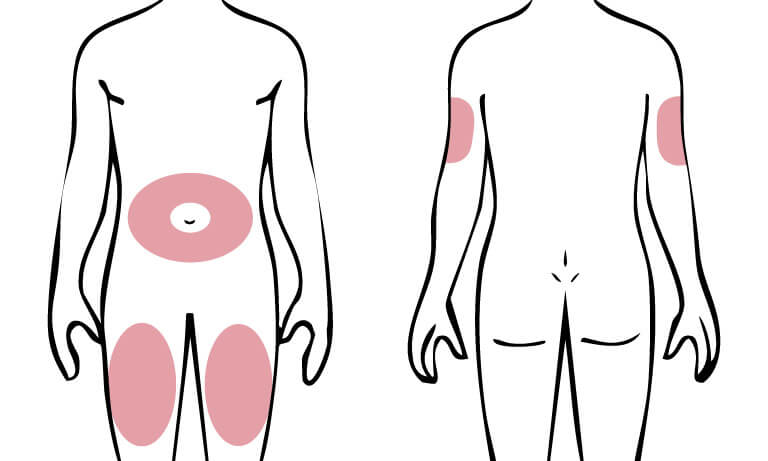 施打猛健樂建議選擇腹部（肚臍周圍）、大腿前外側、上臂外側 (上臂背面)這三個部位