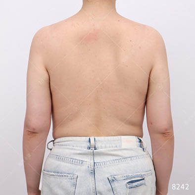 手臂抽脂術後一個月的恢復狀況參考照片，此為個案背面角度的分享